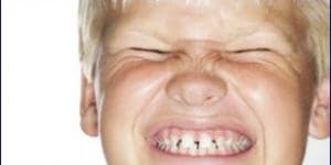 Autistas, bruxismo y el odontólogo Autistas, bruxismo y el odontólogo